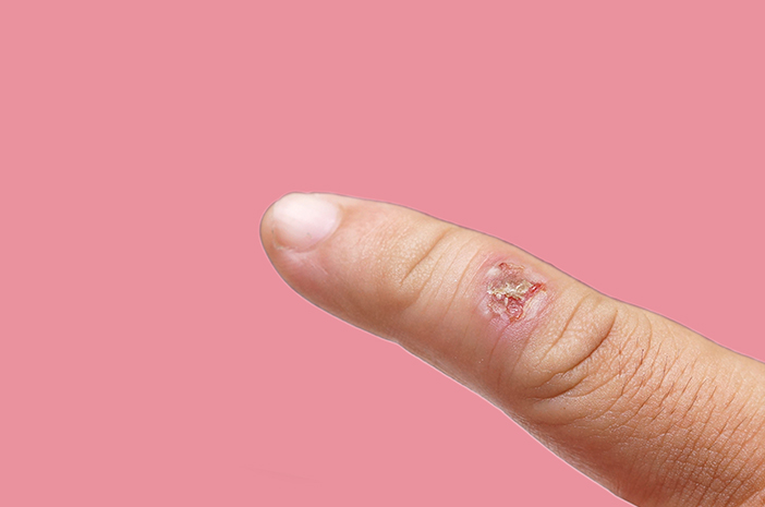 skleroderma, penyakit autoimun skleroderma, penyakit autoimun