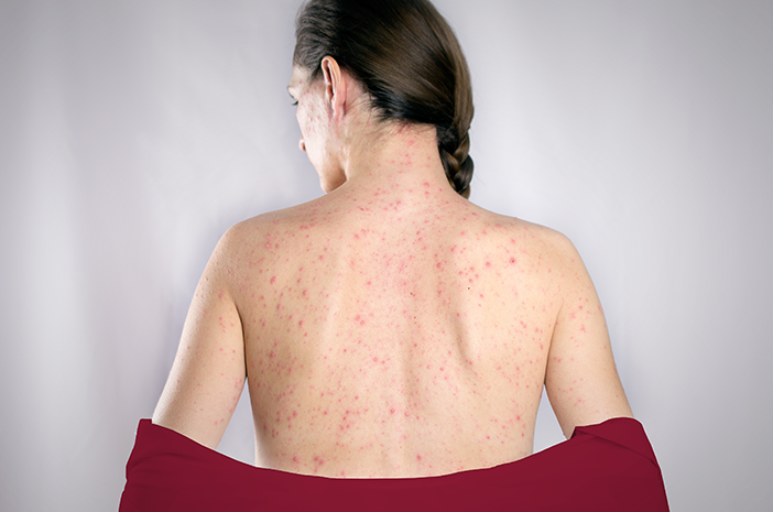 penyakit rubella, katarak akibat rubella, sakit jantung karena rubella penyakit rubella, katarak akibat rubella, sakit jantung karena rubella