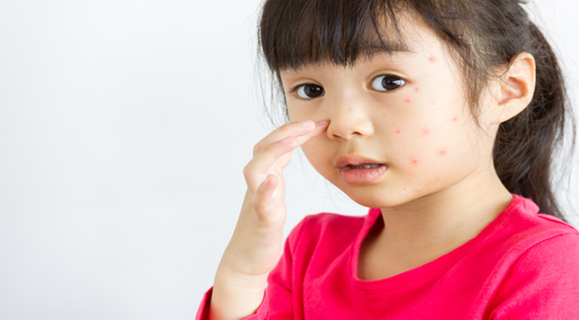 10 Fakta Tentang Lupus yang Perlu Diketahui 10 Fakta Tentang Lupus yang Perlu Diketahui