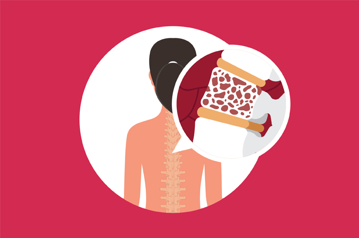 Ketahui 4 Penyebab Osteoporosis pada Wanita