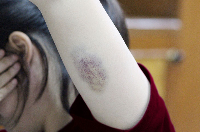 Mirip Memar Kemerahan, Kenali 10 Jenis Hematoma Ini Mirip Memar Kemerahan, Kenali 10 Jenis Hematoma Ini
