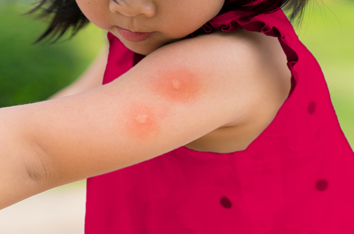 Waspada Japanese Encephalitis (Radang Otak) pada Anak Waspada Japanese Encephalitis (Radang Otak) pada Anak